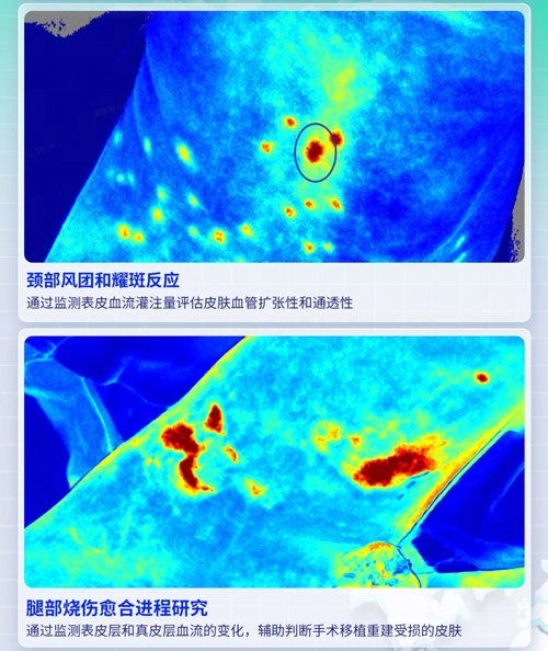 大发88激光散斑血流成像系统获批FDA认证