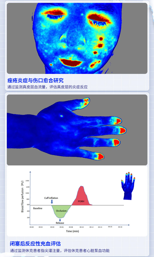 大发88激光散斑血流成像系统获批FDA认证