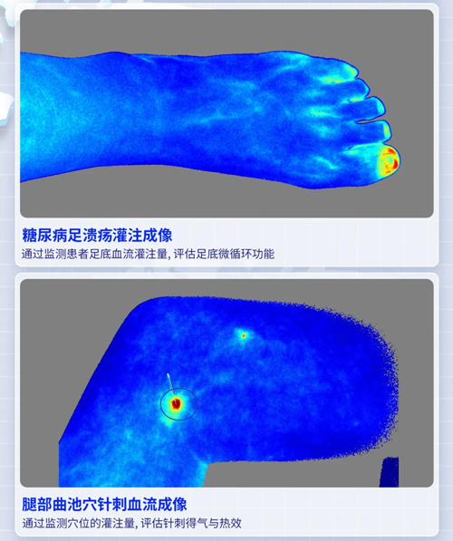 大发88激光散斑血流成像系统获批FDA认证